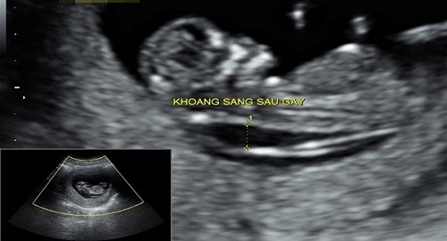 Độ dày da gáy hay còn gọi khoảng sáng sau gáy là sự kết tụ chất dịch dưới da ở vùng gáy. 