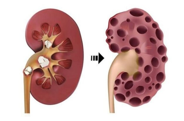 Chế độ ăn uống phù hợp cho người bệnh sỏi thận