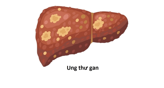 Ung thư gan giai đoạn 2 và các thông tin quan trọng