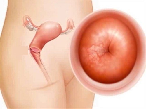 Những triệu chứng viêm lộ tuyến cổ tử cung