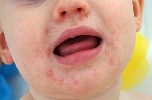 5 bệnh trẻ dễ mắc vào mùa hè Bệnh tay &#8211; chân &#8211; miệng