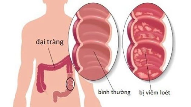 5 triệu chứng cảnh báo bệnh viêm đại tràng bạn cần biết