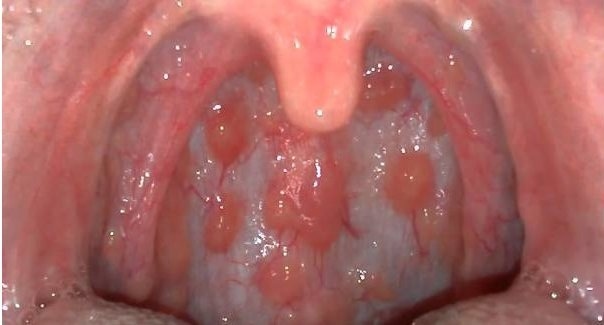 Bệnh viêm họng hạt là gì? bệnh lý khó chữa