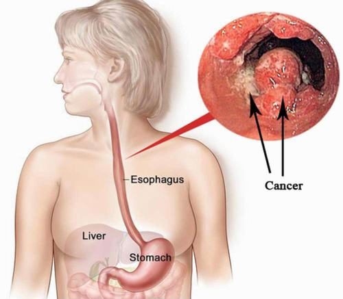 Ung thư thực quản là một trong những bệnh nguy hiểm nhất trong các ung thư tiêu hóa.