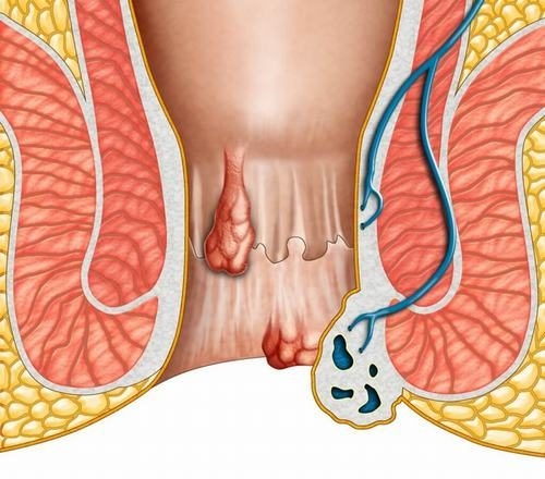 Ung thư hậu môn cũng nguy hiểm và cần được phát hiện, điều trị kịp thời