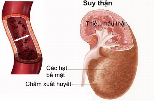 Chạy thận nhân tạo là gì? dùng thuốc thường xuyên