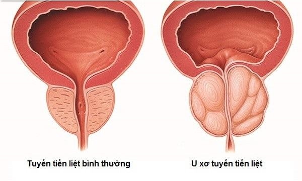 U xơ tuyến tiền liệt là bệnh thường gặp ở nam giới tuổi trung niên. 