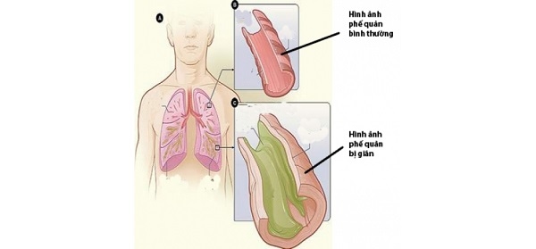 Giãn phế quản là tình trạng giãn không hồi phục các phế quản nhỏ và trung bình kèm theo các lớp phế quản và đa tiết phế quản