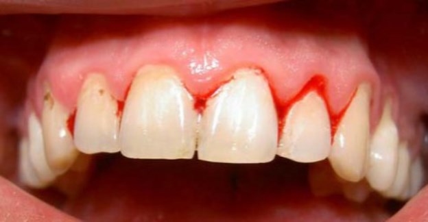 Nguyên nhân nào dẫn đến viêm lợi?