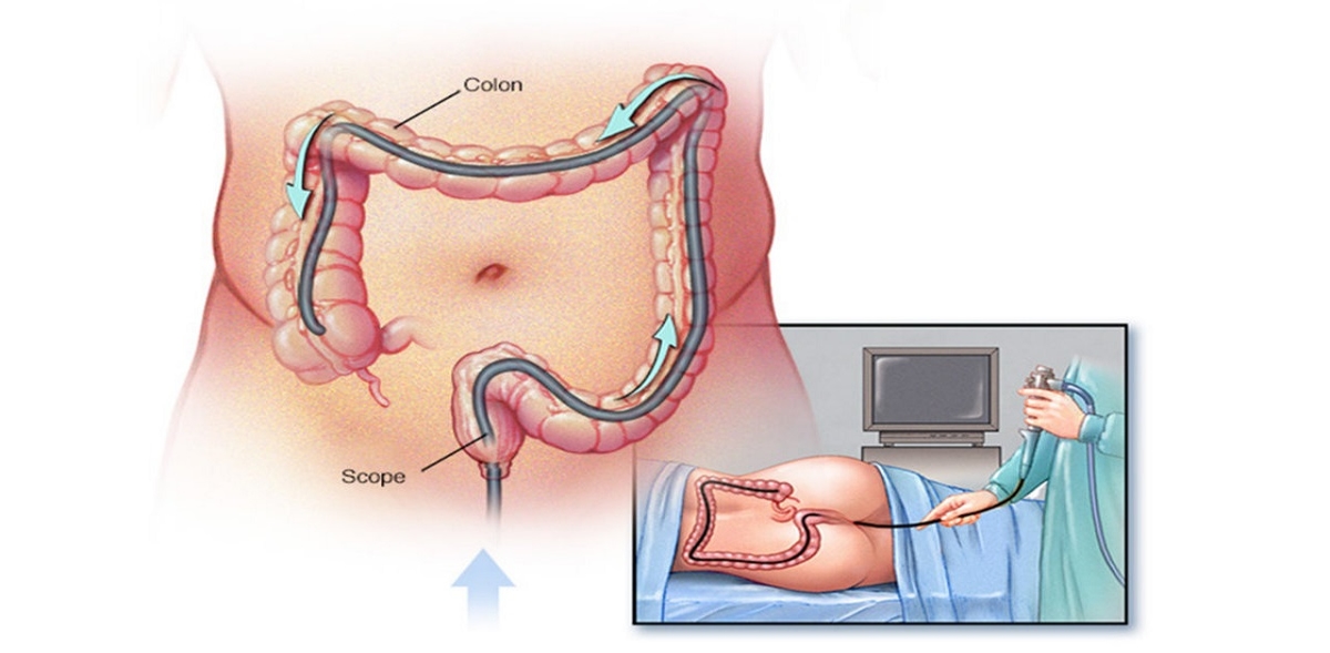 Nội soi đại tràng gây mê bao nhiêu tiền?
