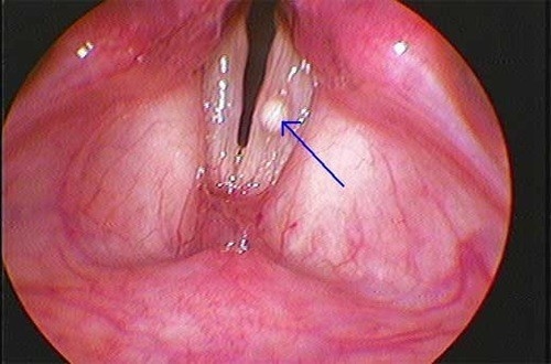 Polyp dây thanh là gì? bằng cách nào để điều trị hiệu quả