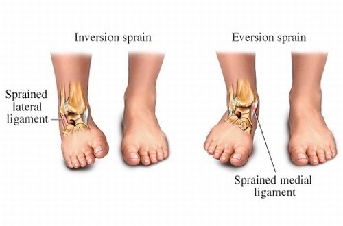 Trật khớp cổ chân phải làm sao để hết đau, sưng tím khớp cổ chân, ảnh hưởng đến khả năng vận động