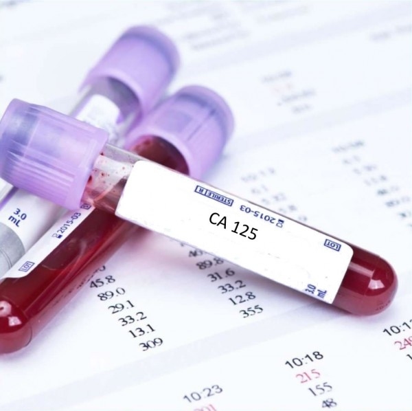 CA 125 là một protein được gọi là chất chỉ điểm ung thư, tìm thấy ở nồng độ cao hơn trong các tế bào khối u so với các tế bào khác của cơ thể