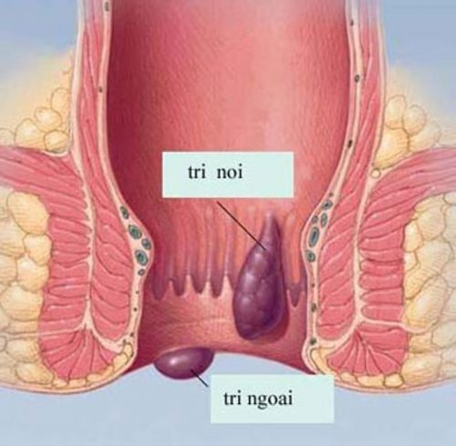 Ngứa hậu môn có thể là triệu chứng của bệnh trĩ