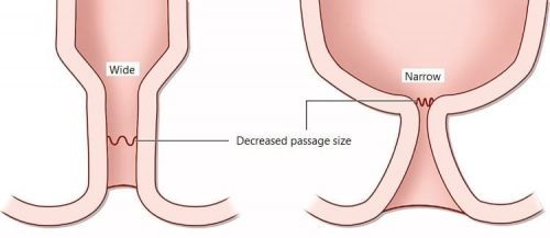 40% người bệnh sau mỗ trĩ phải đối mặt với chứng hẹp hậu môn