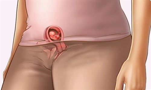 Hiện tượng ra máu âm đạo là một trong những dấu hiệu có thai