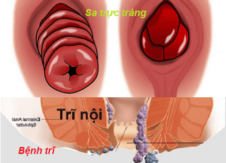 Phân biệt sa trực tràng và trĩ