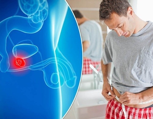 Tại sao bị ung thư tuyến tiền liệt là thắc mắc của nhiều người