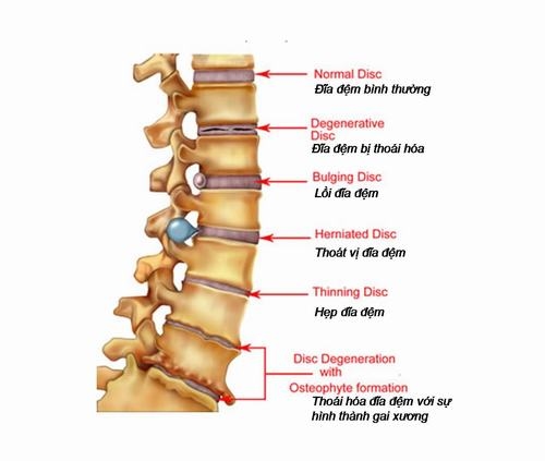 Phồng đĩa đệm đa tầng có thể tiến triển thành thoát vị
