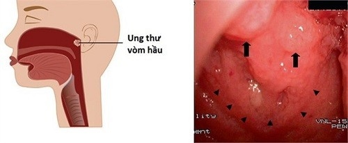 Ung thư vòm họng có thể gặp ở nhiều độ tuổi khác nhau, tỷ lệ cao nhất là 30 – 55 tuổi 