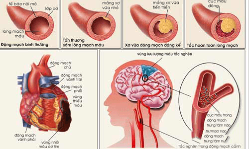 Điều trị xuất huyết não bằng cách nào và hiệu quả đến đâu luôn là vấn đề nhiều người muốn tìm hiểu.