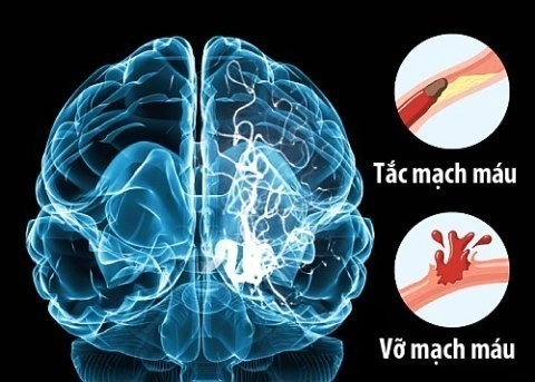 Tỷ lệ người bị xuất huyết não tại Việt Nam và các nước châu Á thường cao hơn so với các nước phương tây.