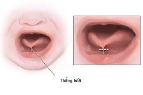 Hình ảnh dính thắng lưỡi ở trẻ: Biết để điều trị sớm