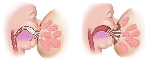 Tình trạng dính thắng lưỡi gây ra các tác hại cho sinh hoạt, sức khỏe của trẻ, cha mẹ nên điều trị cho trẻ càng sớm càng tốt.