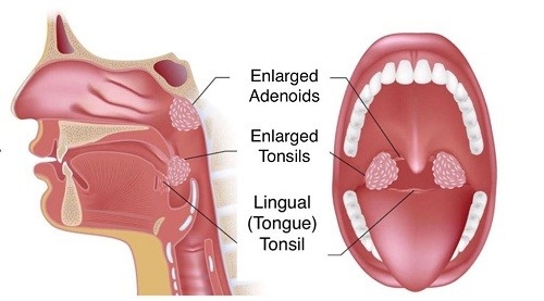 Phẫu thuật bằng dao plasma là kỹ thuật sử dụng đầu dò thông minh và kính soi điện tử, giúp tìm kiếm, tiêu diệt ổ bệnh. 