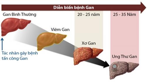 Có khá nhiều nguyên nhân gây ra xơ gan.