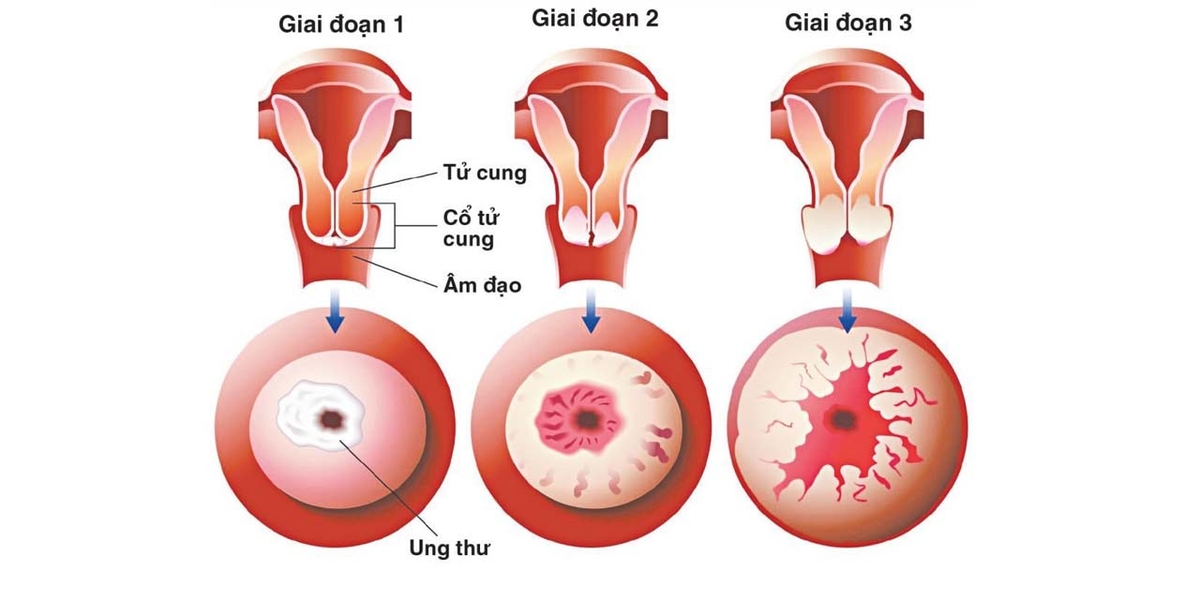 Tiêm ngừa ung thư cổ tử cung mấy mũi?