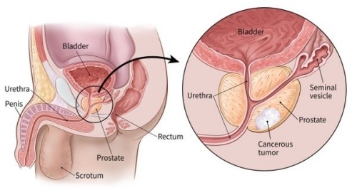 Ung thư tuyến tiền liệt phổ biến trong các bệnh ung thư ở nam giới