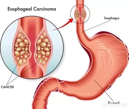 Ung thư thực quản là bệnh ung thư đường tiêu hóa thường gặp