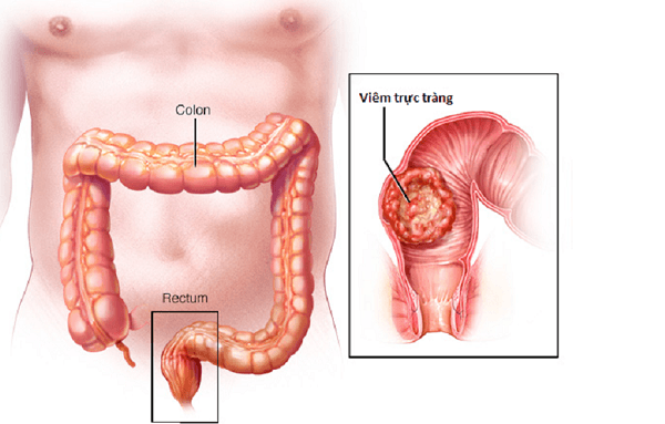 Viêm trực tràng là chỉ tình trạng viêm ở lớp niêm mạc hay các tổ chức xung quanh trực tràng. 