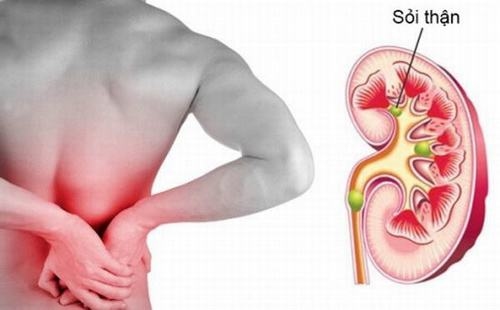 Nguyên nhân gây sỏi thận điều trị bệnh hiệu quả