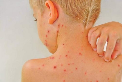 Trẻ bị thủy đậu có được uống sữa không