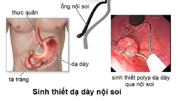 Sinh thiết polyp dạ dày &#8211; phát hiện chính xác ung thư