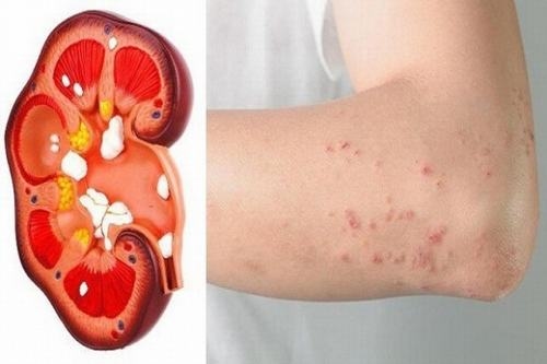 Dấu hiệu suy thận mạn tính gồm có cảm giác tê, ngứa ran, nóng chân và tay cùng một số triệu chứng khác