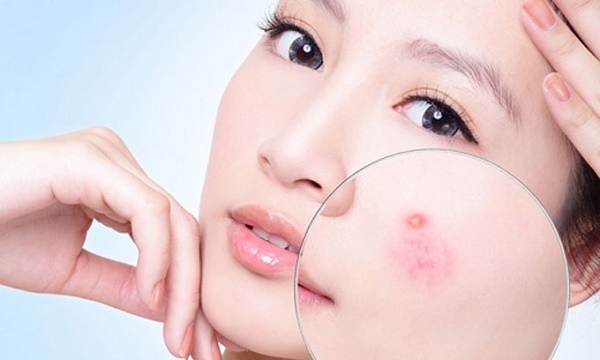 Tưởng bị mụn trứng cá, ai ngờ là&#8230; ung thư da