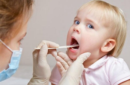 Viêm amidan là bệnh lý đặc biệt phổ biến ở trẻ