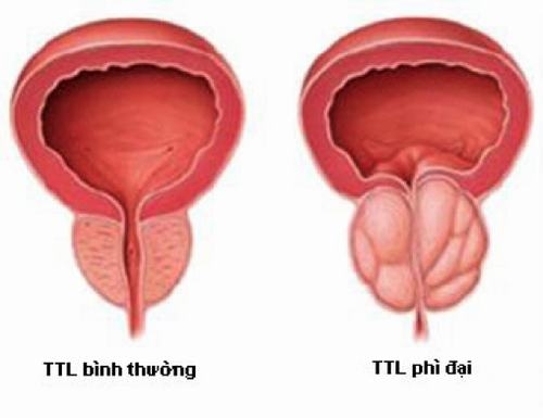 Phì đại tuyến tiền liệt là một bệnh lý rất phổ biến ở nam giới trung niên và cao tuổi. 