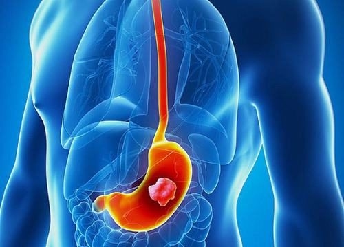 Ung thư dạ dày là bệnh nguy hiểm nên việc phát hiện sớm đóng vai trò vô cùng quan trọng
