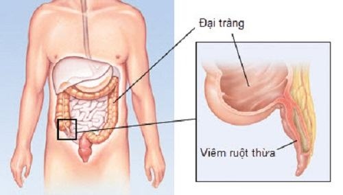 Nhiều người quan tâm muốn biết thời gian của ca mổ ruột thừa kéo dài bao lâu
