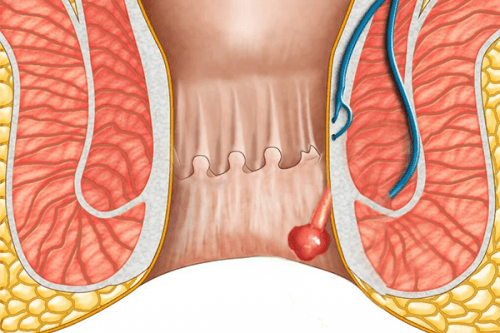 dau-hieu-polyp-hau-mon-1