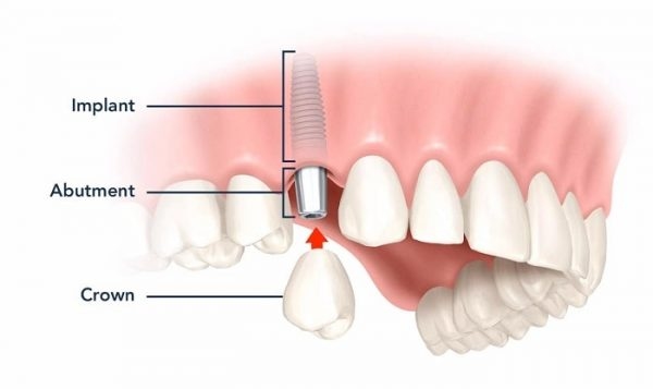 Răng sứ có cấu trúc như răng thật, đảm bảo đẹp tự nhiên và ăn nhai tốt