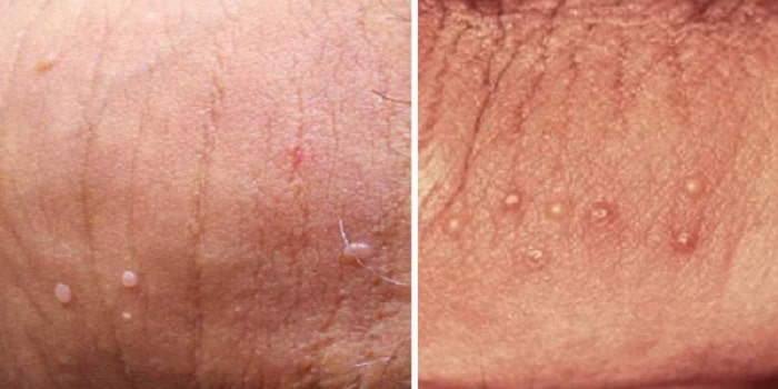 Sùi mào gà giai đoạn đầu: Dấu hiệu nhận biết và cách điều trị