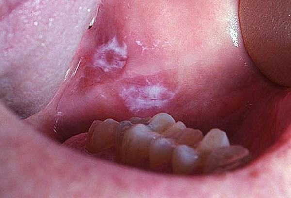 Nam giới uống nhiều rượu bia, hút thuốc có nguy cơ mắc ung thư miệng