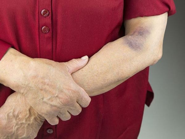 Vết bầm trên da lâu khỏi &#8211; cảnh giác ung thư da