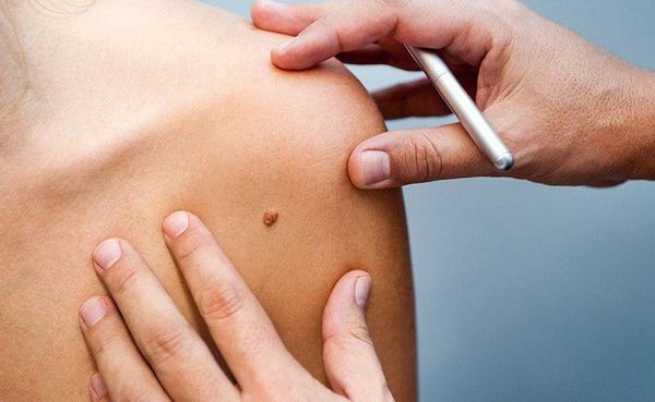 Nốt ruồi ung thư thường khó phát hiện nếu bạn không chú ý