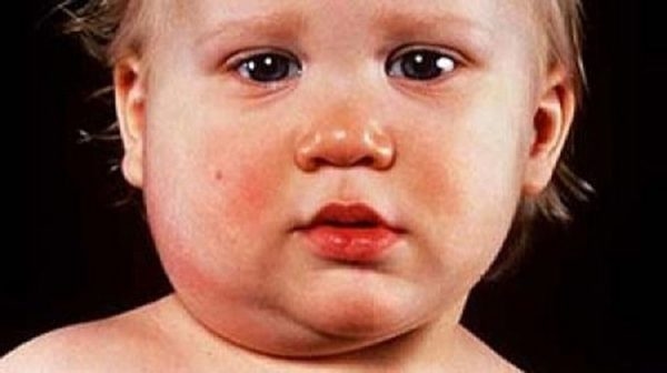 quai bị bao lâu thì khỏi hẳn
